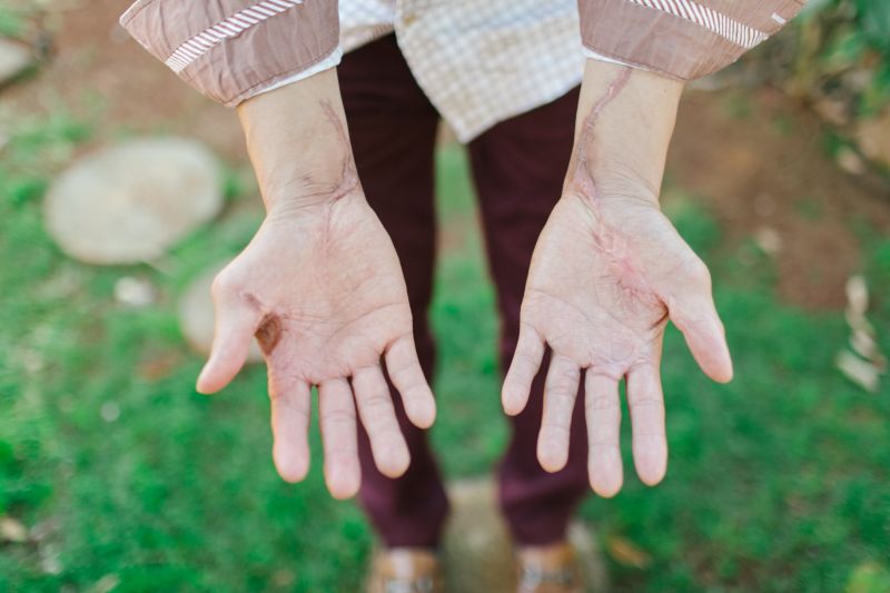 Marcus shares his scars from where the electricity went through his hands